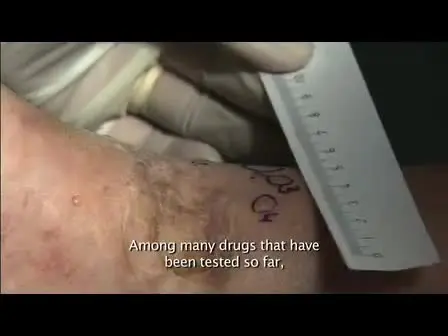 Electrochemotherapy of Tumours