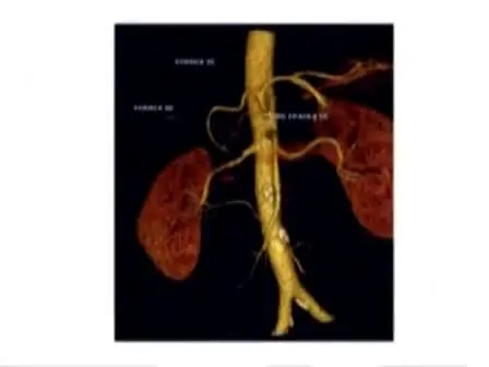 Laparoscopic Left Liver Sectoriectomy of Caroli's Disease Limited to Segment II and III