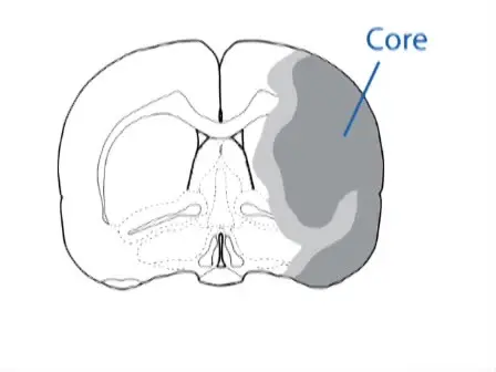 Focal Cerebral Ischemia Model by Endovascular Suture Occlusion of the Middle Cerebral Artery in the Rat