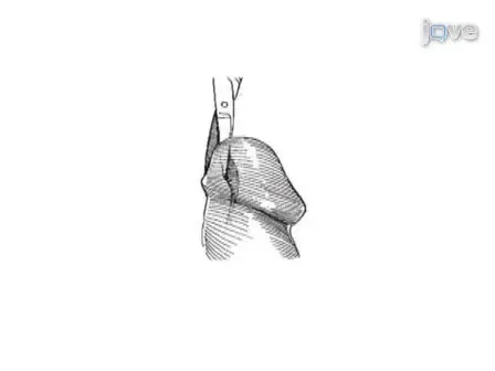 Surgical Management of Meatal Stenosis with Meatoplasty
