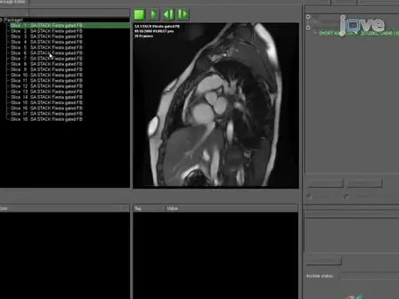 Magnetic Resonance Derived Myocardial Strain Assessment Using Feature Tracking 