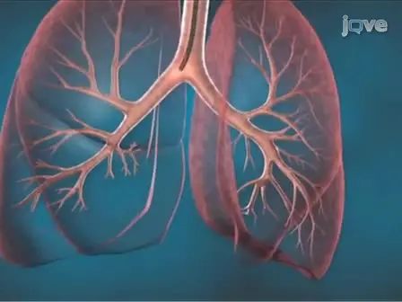 Bronchial Thermoplasty:  A Novel Therapeutic Approach to Severe Asthma
