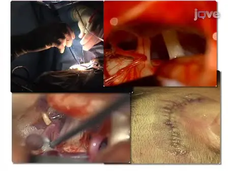 Microvascular Decompression: Salient Surgical Principles and Technical Nuances