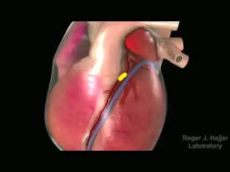 Gene Transfer for Ischemic Heart Failure in a Preclinical Model