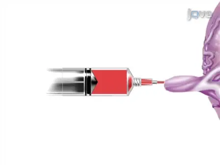 Guide Wire Assisted Catheterization and Colored Dye Injection for Vascular Mapping of Monochorionic Twin Placentas