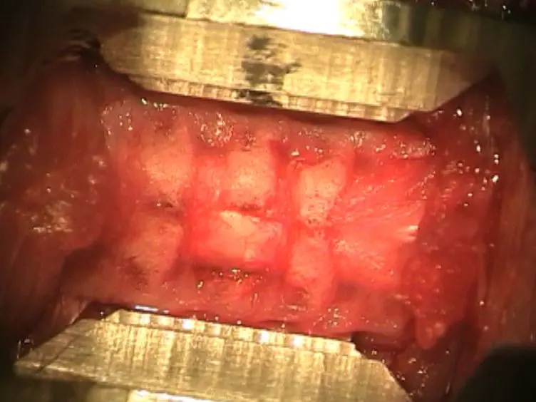A Contusive Model of Unilateral Cervical Spinal Cord Injury Using the Infinite Horizon Impactor