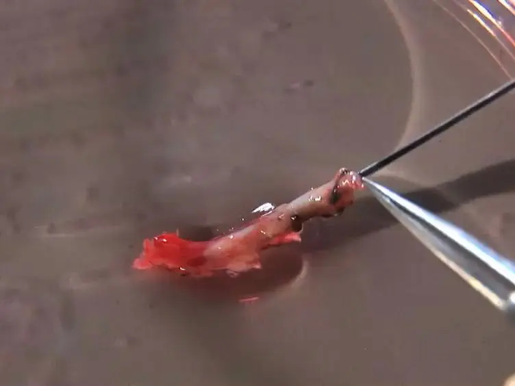 Human Internal Mammary Artery (IMA) Transplantation and Stenting: A Human Model to Study the Development of In-Stent Restenosis