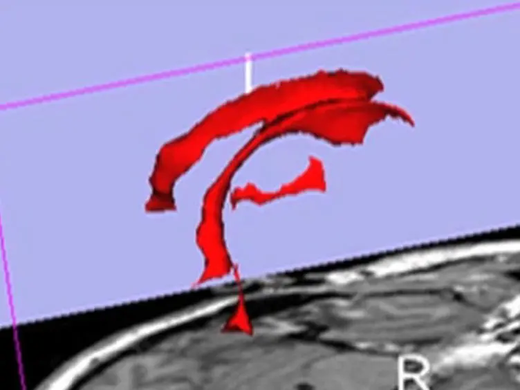 Automated Midline Shift and Intracranial Pressure Estimation based on Brain CT Images