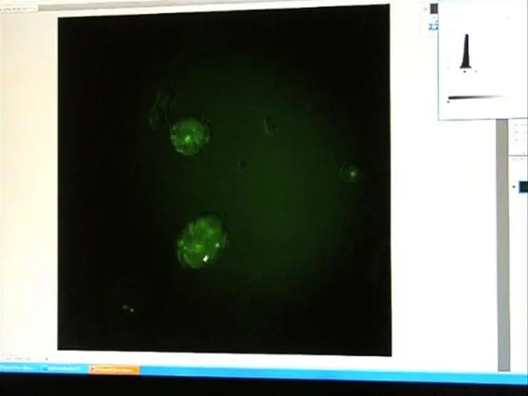 Identification and Isolation of Slow-Dividing Cells in Human Glioblastoma Using Carboxy Fluorescein Succinimidyl Ester (CFSE)