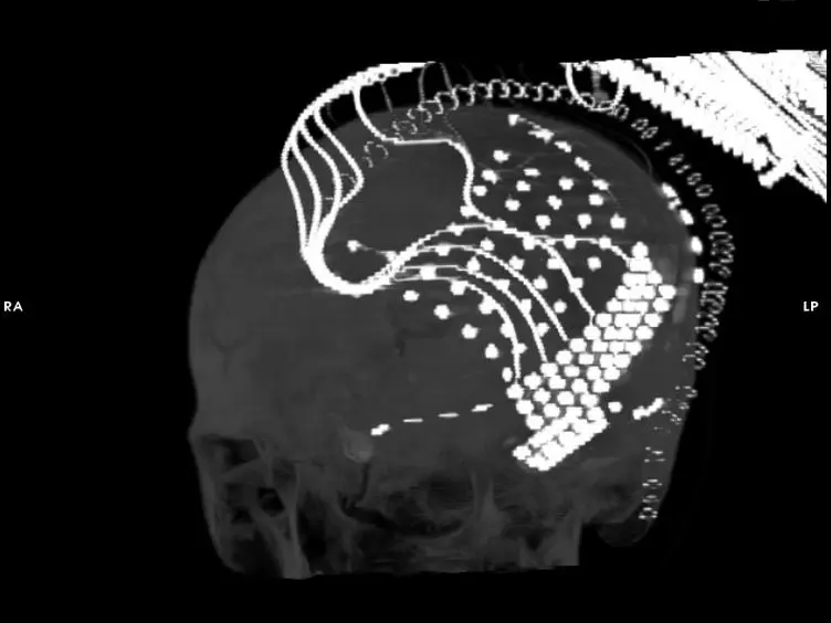 Recording Human Electrocorticographic (ECoG) Signals for Neuroscientific Research and Real-time Functional Cortical Mapping