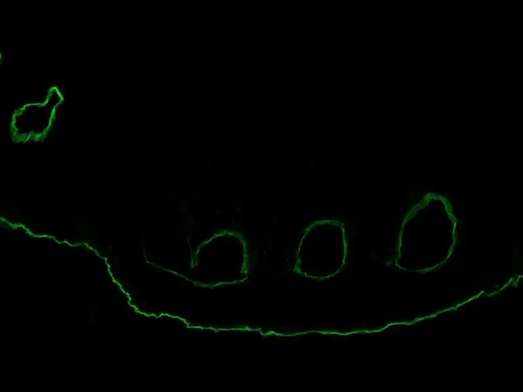 Granulocyte-dependent Autoantibody-induced Skin Blistering