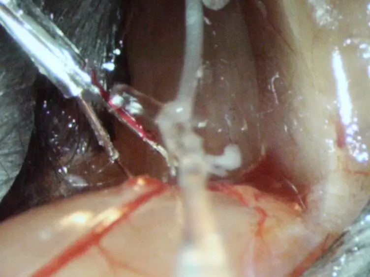 Simultaneous Intracellular Recording of a Lumbar Motoneuron and the Force Produced by its Motor Unit in the Adult Mouse <em>In vivo</em>