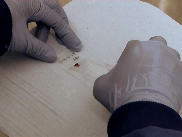 A Simple Protocol for Platelet-mediated Clumping of <em>Plasmodium falciparum</em>-infected Erythrocytes in a Resource Poor Setting