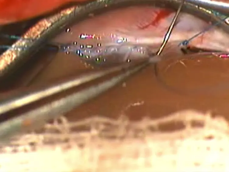 Surgical Procedures for a Rat Model of Partial Orthotopic Liver Transplantation with Hepatic Arterial Reconstruction
