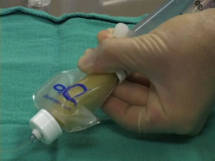Collecting And Measuring Wound Exudate Biochemical Mediators In Surgical Wounds