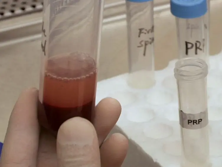 PRP as a New Approach to Prevent Infection: Preparation and <em>In vitro</em> Antimicrobial Properties of PRP