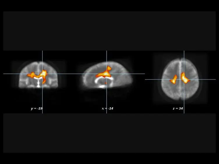 Diffusion Tensor Magnetic Resonance Imaging in the Analysis of Neurodegenerative Diseases