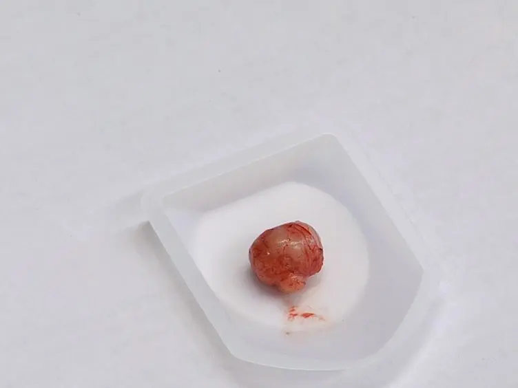 An Orthotopic Murine Model of Human Prostate Cancer Metastasis