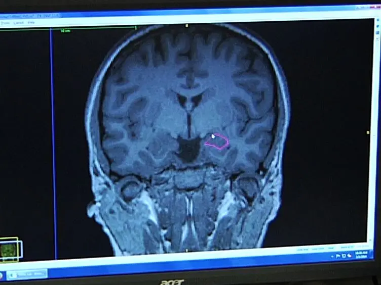 A Comprehensive Protocol for Manual Segmentation of the Medial Temporal Lobe Structures