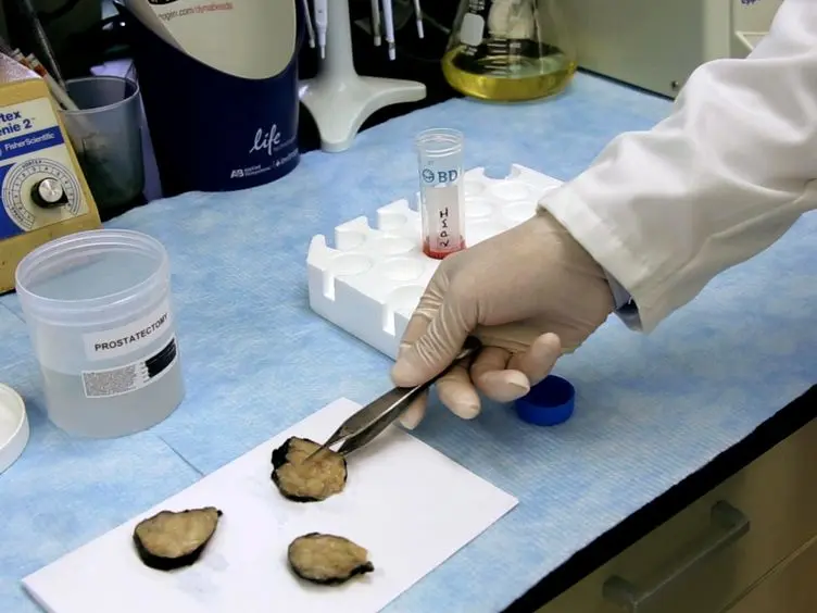 Isolation of Cancer Stem Cells From Human Prostate Cancer Samples