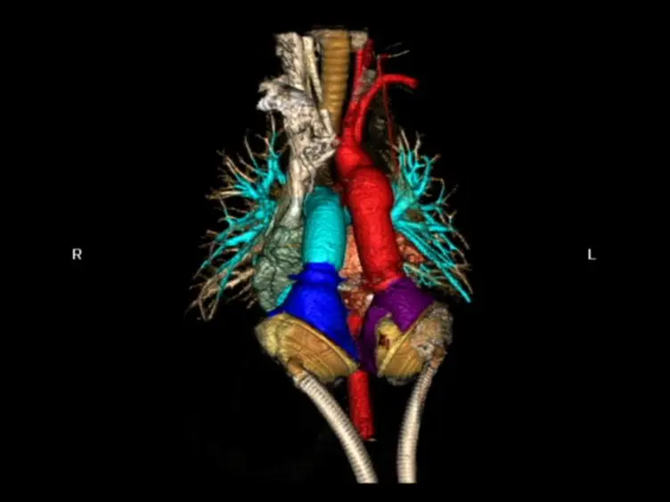 Implantation of Total Artificial Heart in Congenital Heart Disease