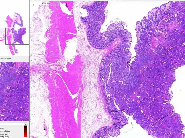 A Next-generation Tissue Microarray (ngTMA) Protocol for Biomarker Studies