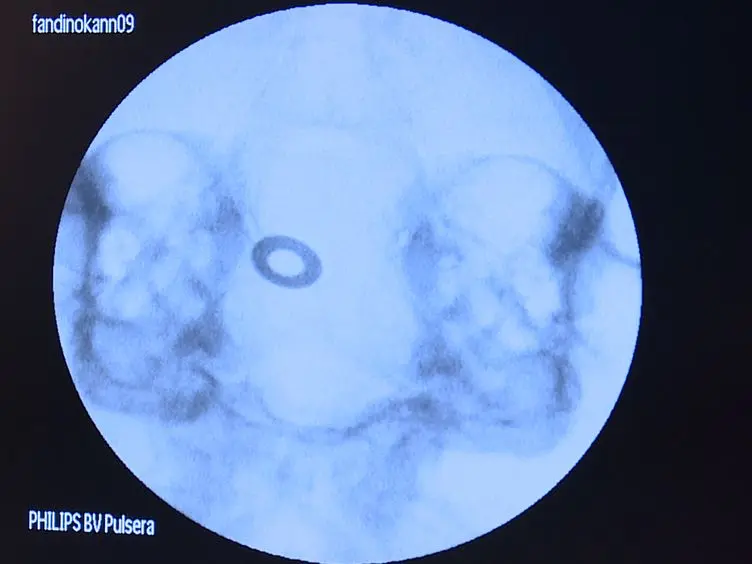 The Rabbit Blood-shunt Model for the Study of Acute and Late Sequelae of Subarachnoid Hemorrhage: Technical Aspects