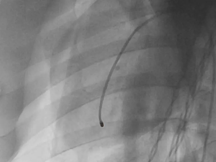 An Injectable and Drug-loaded Supramolecular Hydrogel for Local Catheter Injection into the Pig Heart