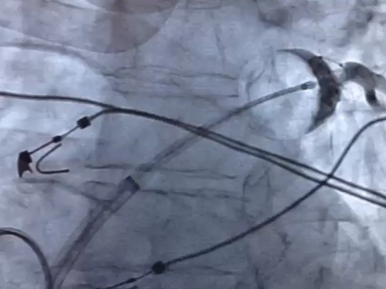 Reduction of Iatrogenic Atrial Septal Defects with an Anterior and Inferior Transseptal Puncture Site when Operating the Cryoballoon Ablation Catheter