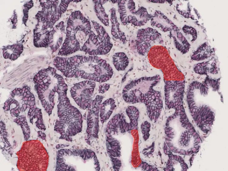 Quantitation of Protein Expression and Co-localization Using Multiplexed Immuno-histochemical Staining and Multispectral Imaging