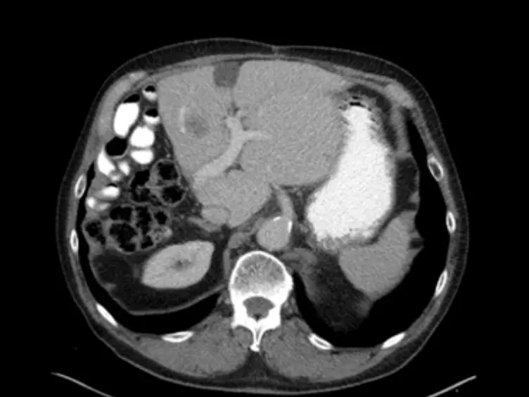 The Influence of Liver Resection on Intrahepatic Tumor Growth