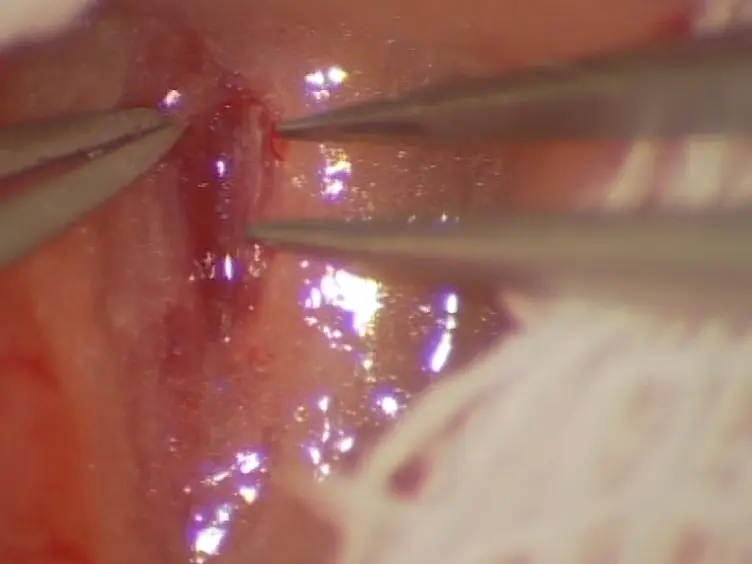 Using the Sleeve Technique in a Mouse Model of Aortic Transplantation - An Instructional Video
