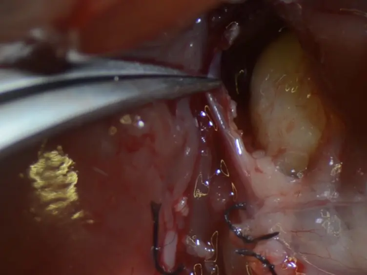 Mouse Model for Pancreas Transplantation Using a Modified Cuff Technique