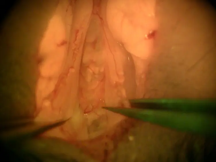 Two Techniques to Create Hypoparathyroid Mice: Parathyroidectomy Using GFP Glands and Diphtheria-Toxin-Mediated Parathyroid Ablation