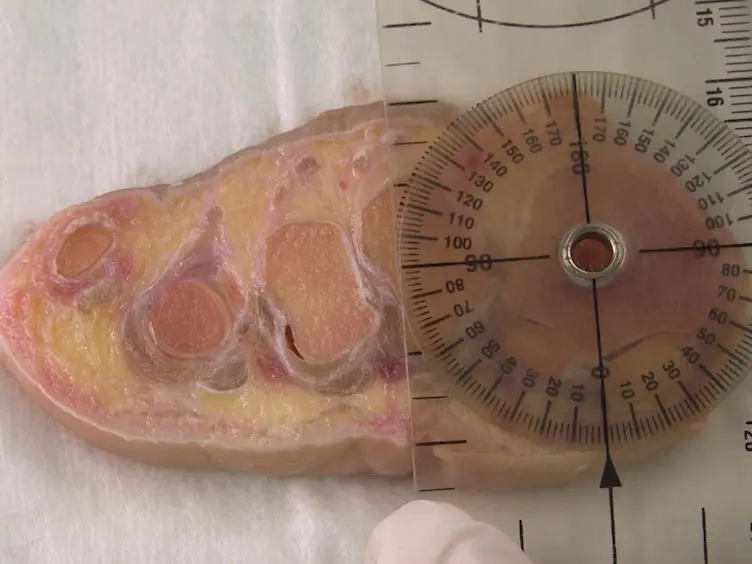 An Anatomical Study of Nerves at Risk During Minimally Invasive Hallux Valgus Surgery