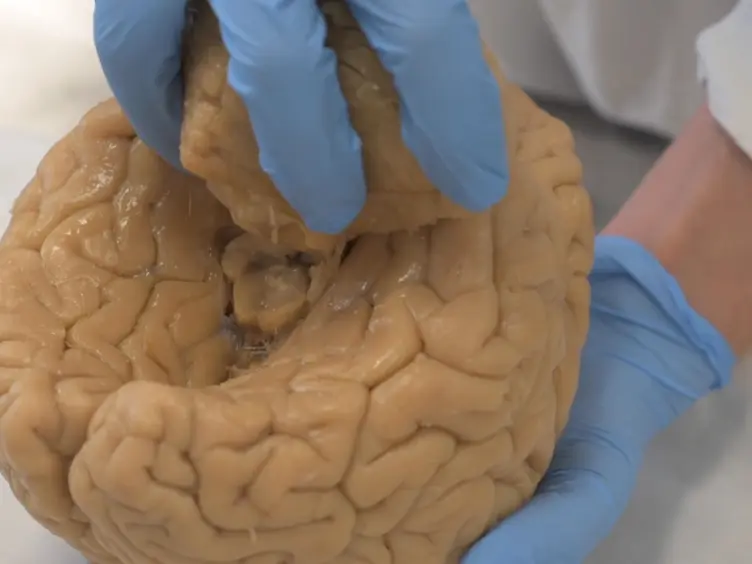 Exploring Deep Space - Uncovering the Anatomy of Periventricular Structures to Reveal the Lateral Ventricles of the Human Brain