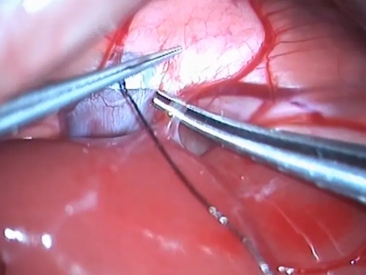 Re-Arterialized Rat Partial Liver Transplantation with an <em>in vivo</em> Vessel-Oriented 70% Hepatectomy