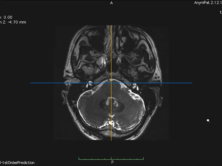 <em>In Vivo</em> Morphometric Analysis of Human Cranial Nerves Using Magnetic Resonance Imaging in Menière's Disease Ears and Normal Hearing Ears