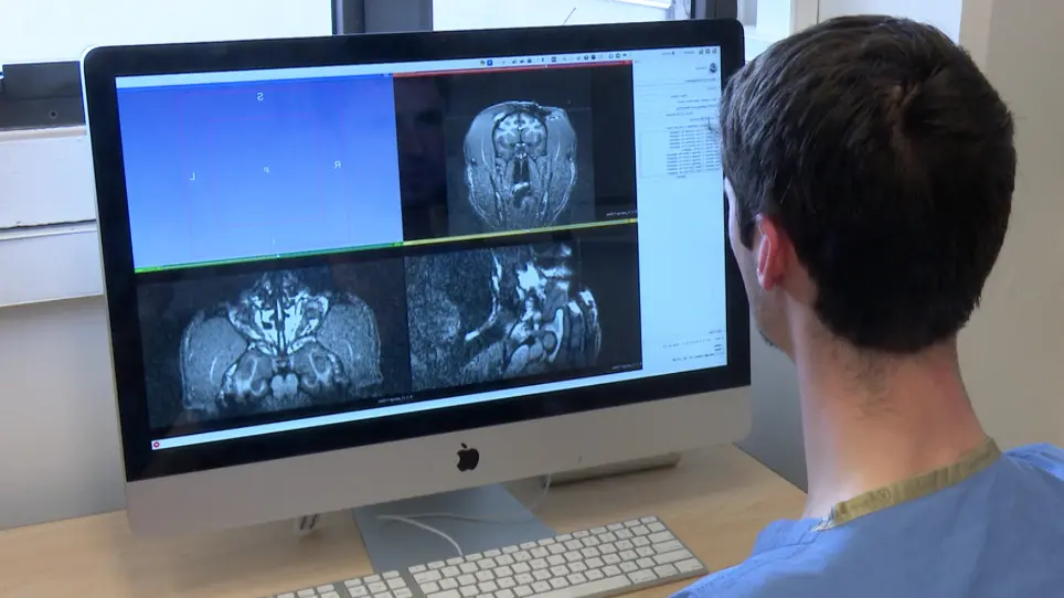 Convection Enhanced Delivery of Optogenetic Adeno-associated Viral Vector to the Cortex of Rhesus Macaque Under Guidance of Online MRI Images