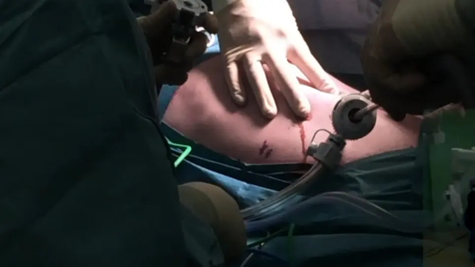 Robotic Lateral Pancreaticojejunostomy for Chronic Pancreatitis