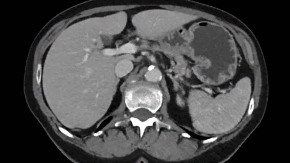 Laparoscopic Radical Left Pancreatectomy for Pancreatic Cancer: Surgical Strategy and Technique Video