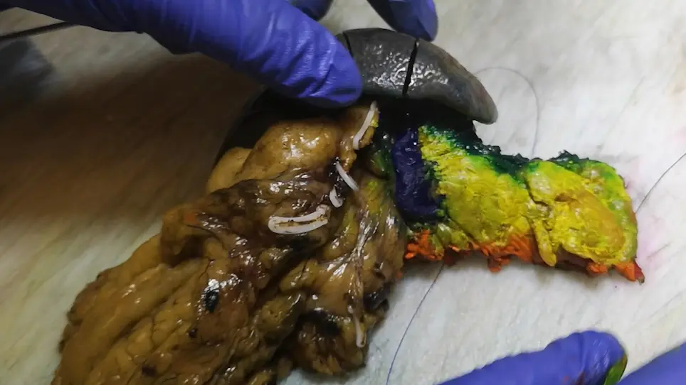 DIPLOMA Approach for Standardized Pathology Assessment of Distal Pancreatectomy Specimens