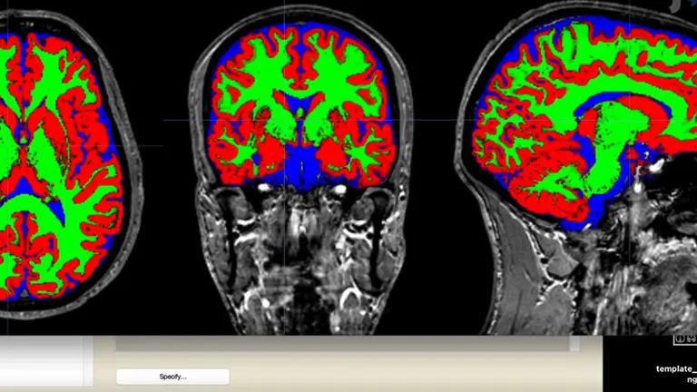 Brain Morphology of Cannabis Users With or Without Psychosis: A Pilot MRI Study