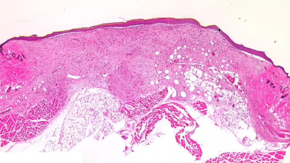 Murine Excisional Wound Healing Model and Histological Morphometric Wound Analysis