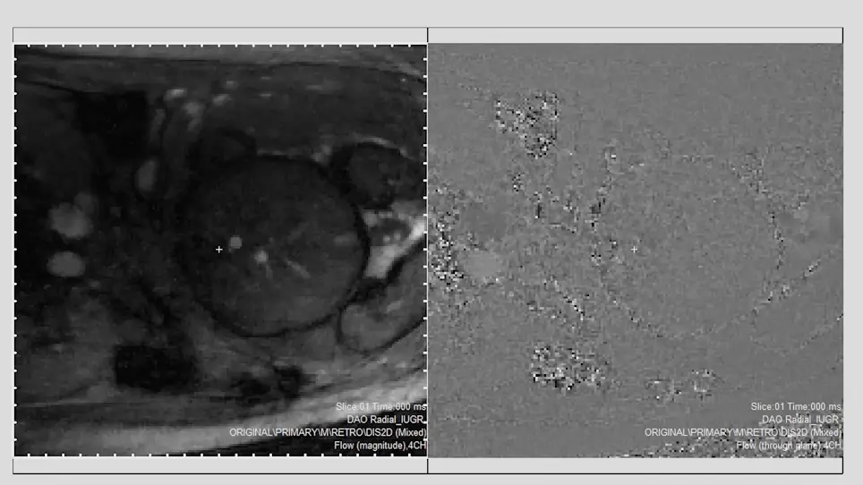 Human Fetal Blood Flow Quantification with Magnetic Resonance Imaging and Motion Compensation