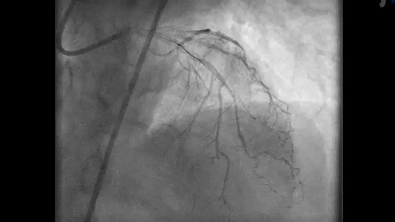 Acetylcholine Re-Challenge After Intracoronary Nitroglycerine Administration