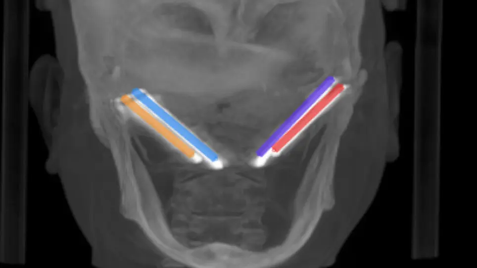 Real-Time Dynamic Navigation System for the Precise Quad-Zygomatic Implant Placement in a Patient with a Severely Atrophic Maxilla
