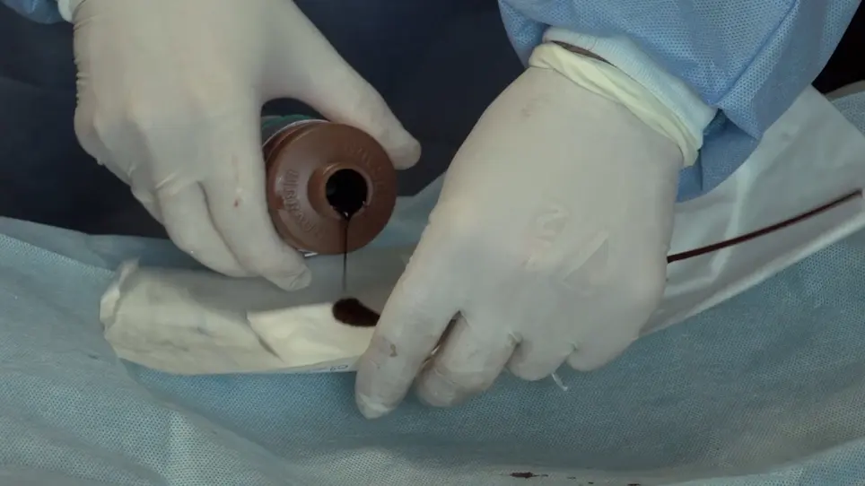 Application of <em>Lucilia sericata</em> Larvae in Debridement of Pressure Wounds in Outpatient Settings