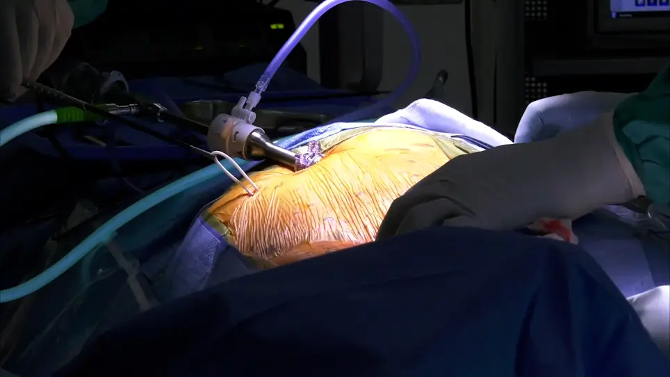 Neuronavigation and Laparoscopy Guided Ventriculoperitoneal Shunt Insertion for the Treatment of Hydrocephalus