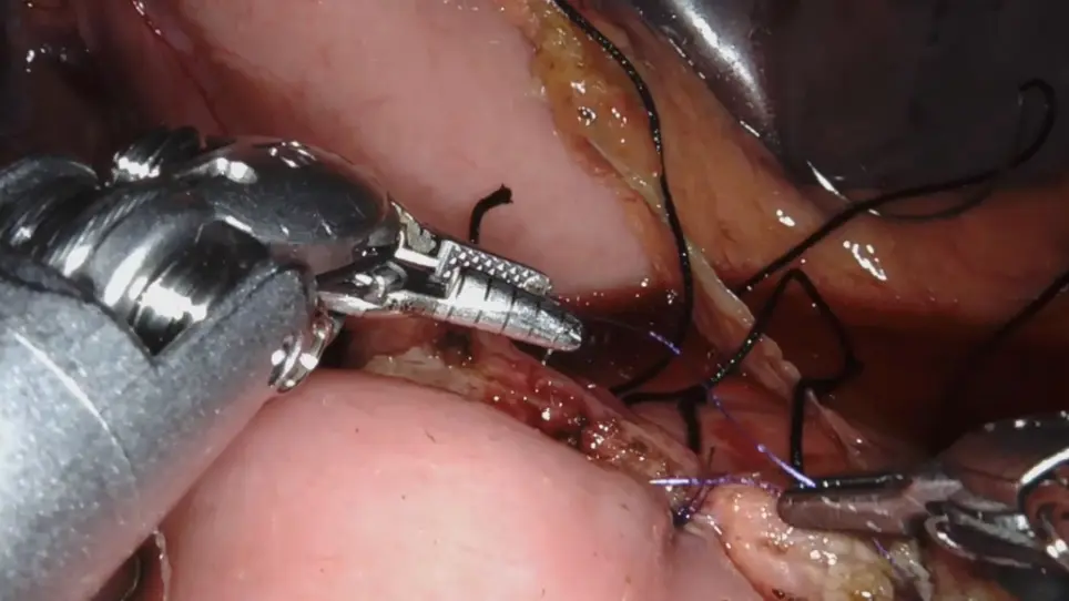 Robotic Central Pancreatectomy with Roux-en-Y Pancreaticojejunostomy